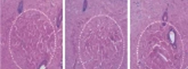 Thermal Coagulation at the target depth