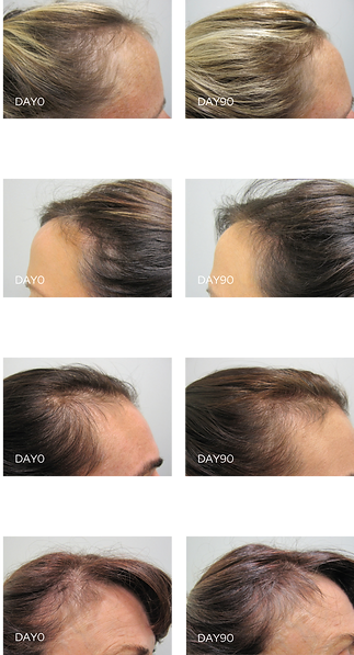 Viviscal Pro before after photos