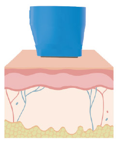 Xtherma Safe Effective Treatment